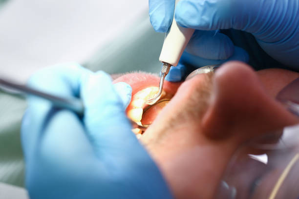 Best Emergency Wisdom Teeth Removal in Dawsonville, GA