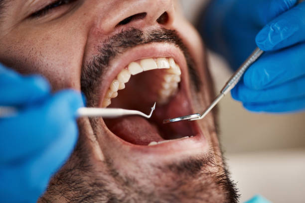 Best Emergency Wisdom Teeth Removal in Dawsonville, GA